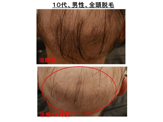 円形脱毛症　病院